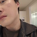 플러스 | 천호피부과 남자수염제모 | 젠틀맥스프로플러스후기, 통증과 효과는?