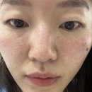 미뉴얼의원 | [동탄 미뉴얼의원 후기] 버츄 + 쥬베룩 3회 내돈내산솔직 후기｜모공+결개선