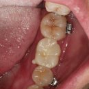 맥스덴치과의원 | 맥스덴치과 부분교정 케이스 #1 - 쓰러진 대구치를 원래자리로