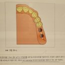 인시전INCISION