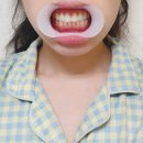 투스노스 | 투스노스 치아미백제 추천 셀프 치아미백 후기 치아변색 관리