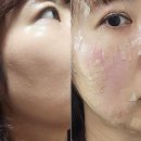 본한의원 | 신림 편평사마귀 제거 신림역 한의원 레이저 시술 받아본 후기