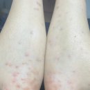 새문한의원 | 23.04.09 건선 일기 2회