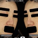 엔의원 | 검버섯, 흑자 치료에서 가장 고민해야 할 것은 ? (동탄 엔의원)