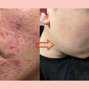 정메디 | 독시메디정 부작용과 여드름 후기 및 효과적인 관리 방법 바로 알기