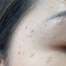 믿음약국 | [리얼후기] 3개월 만에 눈 밑 비립종 극복한 과정