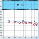 독일보청기 이미지