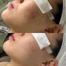 롯데리아마들역점 | [노원] 마들역 피부관리 "브로우림" 여드름성피부 내돈내산 1회차 후기