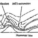 망치 발가락(hammer toe)과 갈퀴발가락(claw toe) 이미지