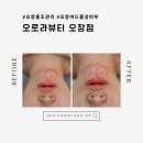 오창 홍조 관리 &amp; 여드름성 피부 케어는 역시 오로라뷰티 오창점![바쿠나 비비엔테 앰플 관리]
