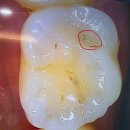 이천바로치과의원 | 이천 바로치과의원 / 과잉진료없는 사랑니 발치 전문치과