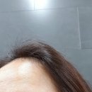 ☆눈썹문신제거☆ 5월 부터 아직도 진행 중인 리얼 후기 - 고려웰니스의원