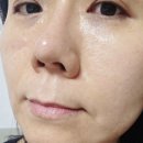 덜아픈세상레이저의료기 | 압구정피부과 통증없는리쥬란으로 촉촉한 피부 관리 비법 후기