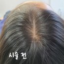 창원 마산 smp두피문신 후기 (가르마,정수리 탈모)