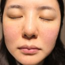 멍단장 | [내돈내산] 선정릉피부과 자가 엑소 좀 줄기세포 주사 후기