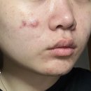 화장품 | 여드름 빨리 없애는법 화농성 여드름 화장품 후기