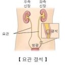 요로결석에 안좋은 음식 및 증상 알아봐요 이미지