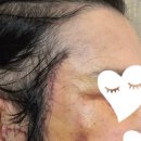 LK성형외과의원 | 광주 성형외과의원 50대 중반 남성 안면, 얼굴(중하안면부 거상) 수술 후기