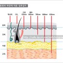 레이저의 작용기전(수정) 이미지