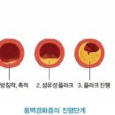 경화반점 이미지