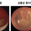 귀가 먹먹할때 한쪽 귀 먹먹 원인 및 대처 이미지