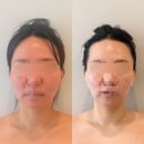 공병임헤어아트 | [Wedding. 06]김포 웨딩관리 시작! 내돈내산 구래동 에스테티아 얼굴 윤곽관리 1회 전후 후기