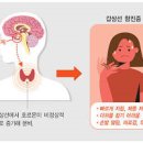 갑상선항진증 증상과 원인, 놓치기 쉬운 초기 신호 알아보기 이미지