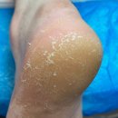 하얀네일 | 울산 발각질제거샵 쓰담네일 레푸스 언양점 하얀 발바닥 각질 관리 후기