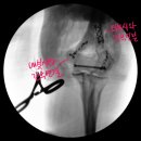 오에스소독 | 고령의 상완골 원위부 관절 내 골절 (Distal humerus intra-articular Fracture)의 성공적인 치료 후기