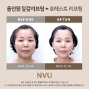엔비유의원 | 60대 거상술 부담 없이 V라인 되찾은 임상 사례 (올인원 달걀리프팅 + 포레스트리프팅 후기 )