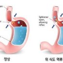 명치 통증 답답함 원인 이미지