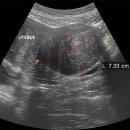 LOWER ABDOMINAL PAIN을 동반한 UETRINE LEIOMYOMA 이미지