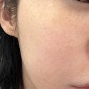 오롯의원 | 흑석역피부과 포토나토닝 기미 잡티 색소레이저 후기