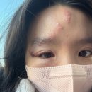 (주)더오 | 20대 대상포진 걸린 후기ㅜㅜ (휴유증, 증상)