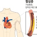 협심증 angina pectoris 이미지