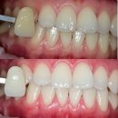 이데아치과의원 | 동대문치과 치아미백 후기 강북 중랑구 라미네이트 상담