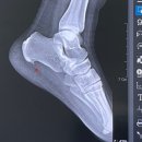 튼튼한 정형외과 | [족저근막염 완치 기록] 발뒷꿈치통증 병원 후기 [진주 정형외과 튼튼한정형외과]