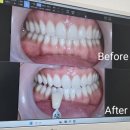 L&B치과의원 | 신사역치과 신사역치아미백 레브치과 원데이미백 후기