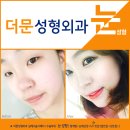 더문성형외과 네이버블로그