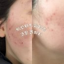 익산여드름압출 고운결뷰티 내돈내산만족후기