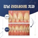 청라퍼스널치과의원 | 강남라미네이트 치과 잘하는곳 체크리스트