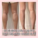 압구정찜질방사우나 | 압구정 피부과 종아리보톡스 3회차 후기 근육주사 지방분해주사 부종주사 부작용 관리법