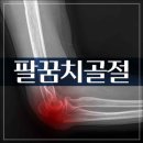 조일배드민턴 위쪽 | 팔꿈치 골절 증상과 깁스 관리 후기