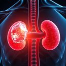 닥터철비뇨의학과의원 | 요로결석 통증 수준 및 쇄석술 비용 실비 청구 미리 모르면 후회하는 필수 정보