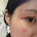 미의원 | 부산대 미의원 내돈내산 흑자 제거 후기