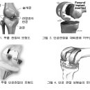 인공관절 수술과, 고관절 질환 치료 이미지