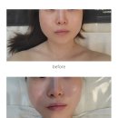 토평초등학교(병설) | 구리에스테틱 봉에스떼 / 리프팅맛집 비포애프터 확실한 이곳!!