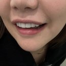 리메인의원 | 라미네이트후기 신논현치과 강남역치과 라미네이트내돈내산 체리스마일치과 라미네이트당일제작 라미네이트