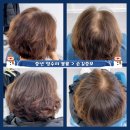 중년 정수리가발, 헤어증모술로 해결