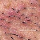 캔디스뷰티살롱 | [정자동왁싱 : 캔디스뷰티살롱] 왁싱 후 왁싱부위 관리법 1 : 브라질리언 왁싱 편